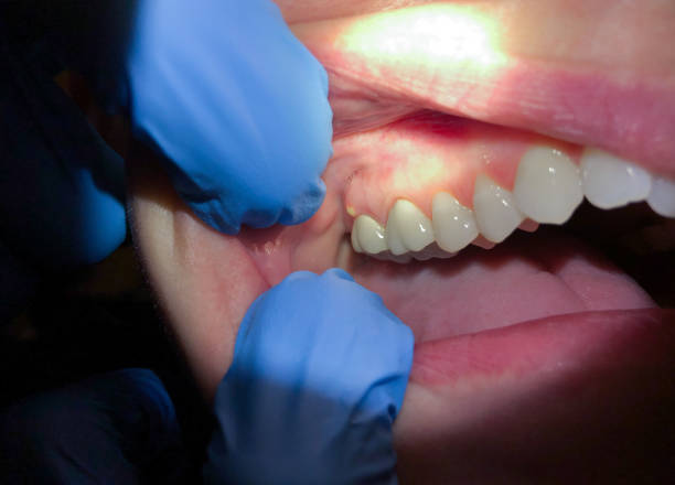 Best Root Canal Emergency Dentist  in Ocean City, NJ